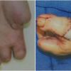 Doctors Amputate Woman's Toe to Replace Thumb